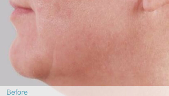 BTL exilis 360 - Face-07