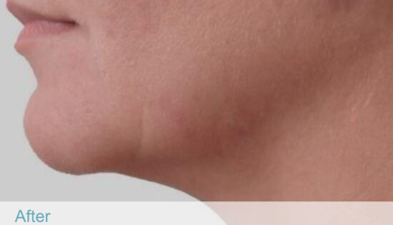 BTL exilis 360 - Face-08