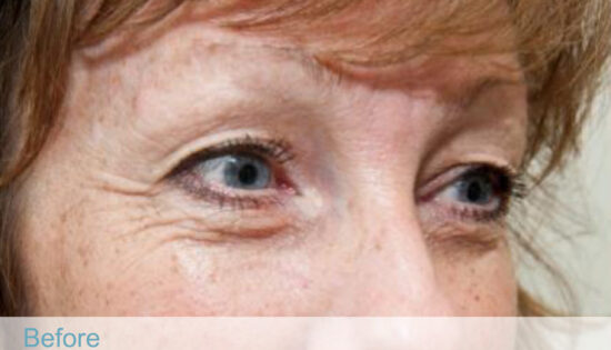 BTL exilis 360 - Face-09