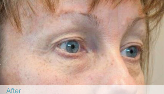 BTL exilis 360 - Face-10