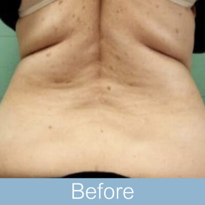 BTL exilis 360 - Body-05