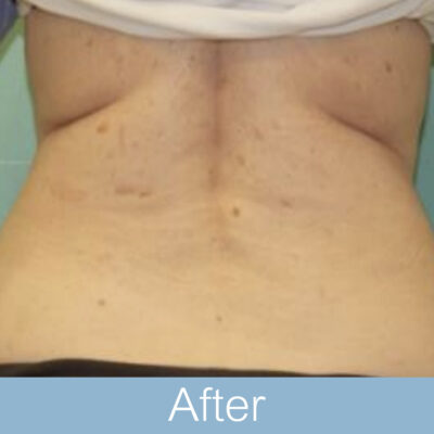 BTL exilis 360 - Body-06