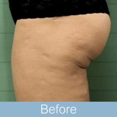 BTL exilis 360 - Body-07