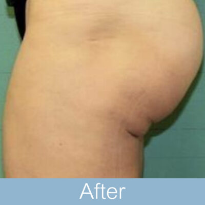 BTL exilis 360 - Body-08